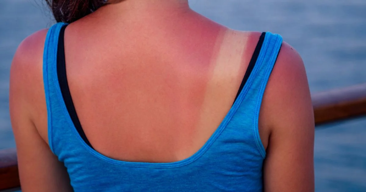 A person with a visible sunburn on their upper back and shoulders, wearing a blue tank top